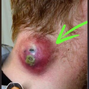 Acne And Everything You Need To Know About Them