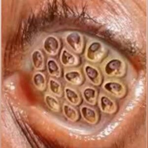 Understanding Common Eye Infections: Symptoms, Treatments, and Prevention