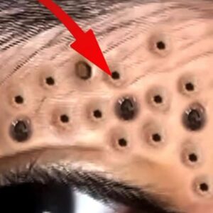 Their acne is severe Their acne is severe