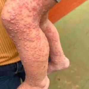 Her Whole Body Was Itchy: What She Thought Was a Common Allergy Was Hiding Something More Serious Her Whole Body Was Itchy: What She Thought Was a Common Allergy Was Hiding Something More Serious