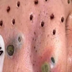 Their acne is severe Their acne is severe