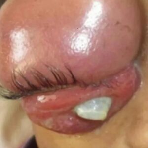 Body Acne: 4 Tips To Get Rid Of Them Body Acne: 4 Tips To Get Rid Of Them