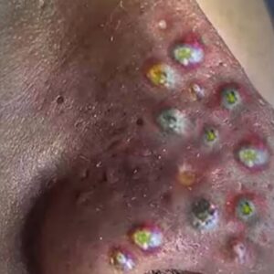 Their acne is severe Their acne is severe