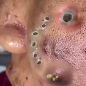 Their acne is severe Their acne is severe