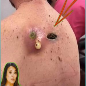 Acne And Everything You Need To Know About Them Acne And Everything You Need To Know About Them