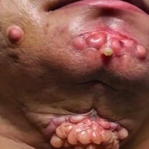 Their acne is severe Their acne is severe
