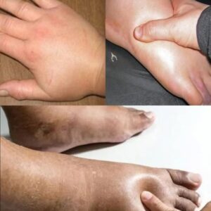 Get Rid of Swollen Hands & Feet Fast: Home Remedies for Water Retention Get Rid of Swollen Hands & Feet Fast: Home Remedies for Water Retention