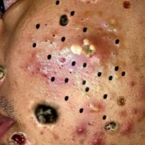 Their acne is severe Their acne is severe