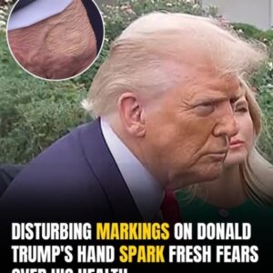 Concerning Marks On Trump’s Hand? Experts Reveal What They Really Are Concerning Marks On Trump’s Hand? Experts Reveal What They Really Are