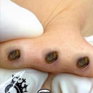 Their acne is severe