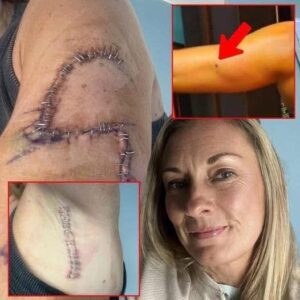 1-TG She Thought It Was Just A Mole… 77 Stitches Later, Doctors Told Her The Truth…