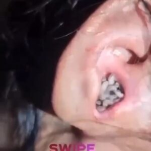 Their acne is severe