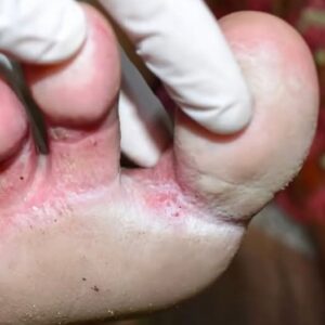 Looks like a infection between my toes. Can’t get medical advice for now. Any over-the-counter remedies?. Full article Looks like a infection between my toes. Can’t get medical advice for now. Any over-the-counter remedies?. Full article