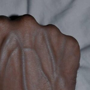 5 Health Conditions That Can Cause Visible Veins 5 Health Conditions That Can Cause Visible Veins
