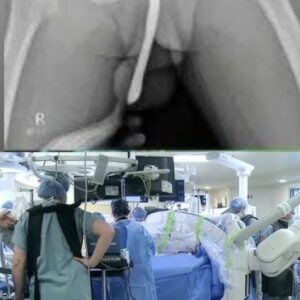 A young girl was hospitalized after attempting to use a male urination device A young girl was hospitalized after attempting to use a male urination device