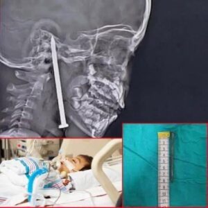 Year-Old Boy Survives After 3-Inch Nail Pierces His Brain In Shocking Playground Accident Year-Old Boy Survives After 3-Inch Nail Pierces His Brain In Shocking Playground Accident