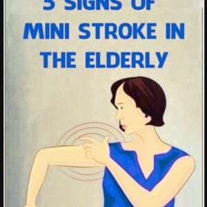 Understanding Mini Strokes in the Elderly Understanding Mini Strokes in the Elderly