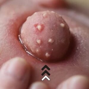 Their acne is severe