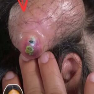 Their acne is severe