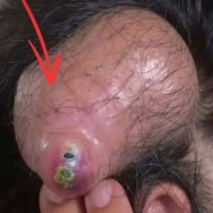 Their acne is severe