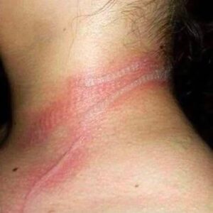 girl left with horrific burns on her neck girl left with horrific burns on her neck
