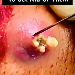 Their acne is severe