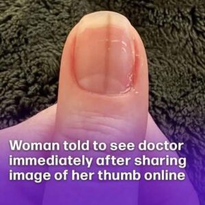 Woman told to see doctor immediately after sharing image of her thumb online