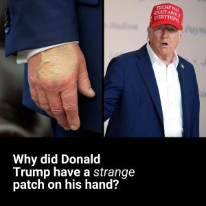Extent of Donald Trump’s dark hand bruising revealed days after he covered it up Extent of Donald Trump’s dark hand bruising revealed days after he covered it up