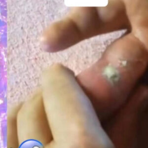 Their acne is severe