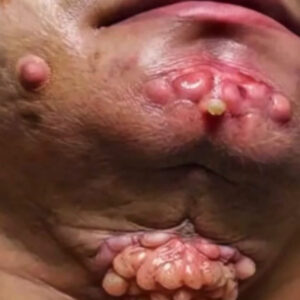Their acne is severe