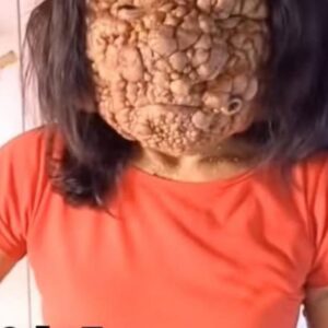 Their acne is severe