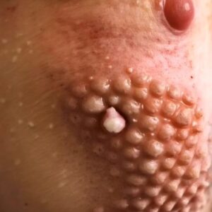 Their acne is severe Their acne is severe