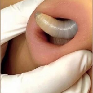 Why You Keep Getting Pimples Inside Your
