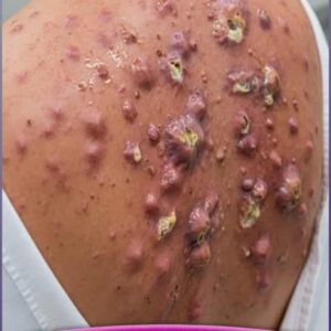Their acne is severe
