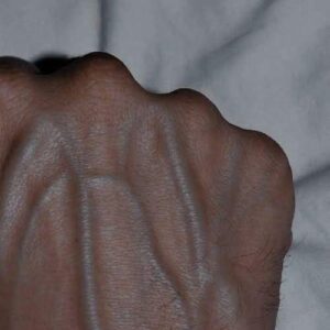 If your veins are visible in your hand, it is a signal of ca… See more