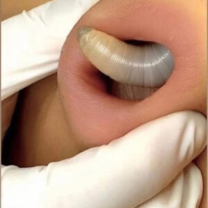 Why You Keep Getting Pimples Inside Your