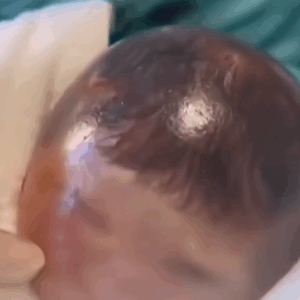 Baby born with an DIU peg Baby born with an DIU peg