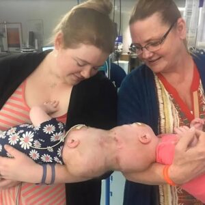 These Siamese sisters were born with their heads