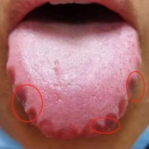 If You See Teeth Marks on the Sides of Your Tongue, Here’s What Your Body Is Saying…See More