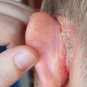 “I found a strange patch of skin on my son’s ear this morning. His doctor appointment is a week away — what should I do meanwhile? Full article “