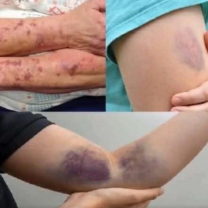BE CAREFUL, if you get these bruises on your body, it means you have Ca…see more