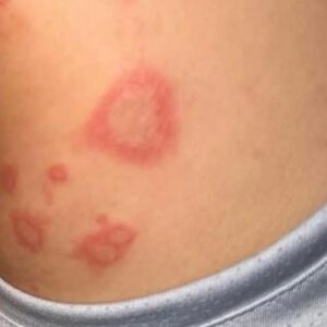 My 15 year old son been at his Nanny house for the weekend and he came back home with different sizes of bumps ..