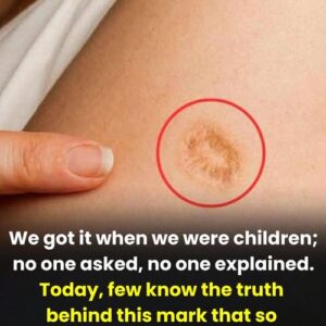 The BCG Mark: Decoding the Science and Stigma of the World’s Most Common Scar