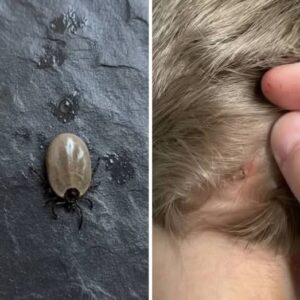 A Tiny Surprise in Your Child’s Hair: A Calm Guide for Parents When You Find a Bug
