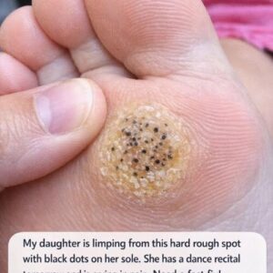 My daughter is limping from this hard rough spot with black dots on her sole. She has a dance recital tomorrow and is crying in pain. Need a fast fix!