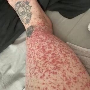 These are the consequences of sle