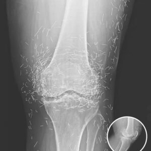 Doctors Stunned After Looking At This X-Ray Of Woman Suffering Joint Pain