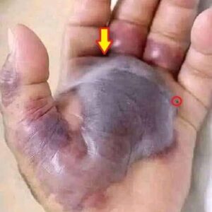 Doctors Are Warning Everyone This Small Bite Turned a Hand Black, And It Could Happen to Anyone