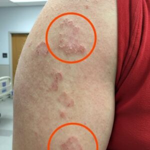 If you see red marks appearing on your arm, that’s a sign of ca…