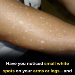 What Vitamin Deficiencies May Lead to White Spots on the Skin